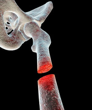 Study: CBD Helps Heal Bone Fractures