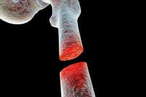 Study: CBD Helps Heal Bone Fractures